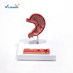 Modèle d'ulcère gastrique, modèle de perforation gastrique, modèle pédagogique de pathologie de l'estomac humain, modèle de coupe transversale gastrique - Product Image 5