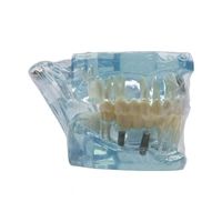 Modèle dentaire amovible de pont de restauration de dents modèle de maladie de dent d'implant