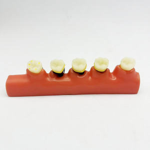 Medische Wetenschap Dummy Parodontitis Classificatie Tandheelkundig Model Voor Medische Schoolopleiding - Product Image 6