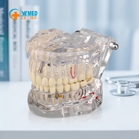 Modelo de Resina Desmontable para Implantes Dentales y Dientes Patológicos, Demostración de Cuidado Bucal y Puentes y Coronas de PVC para Ciencia Médica CE