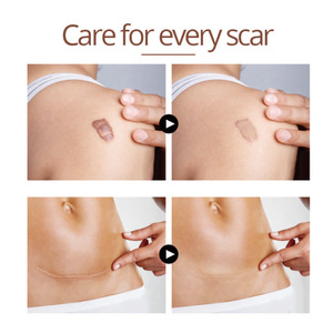 ชุดกำจัดรอยแผลเป็นจากสิว,ชุดครีมสำหรับลบรอย<span class=keywords><strong>สิว</strong></span>แผลเป็นจาก<span class=keywords><strong>สิว</strong></span> - Product Image 4