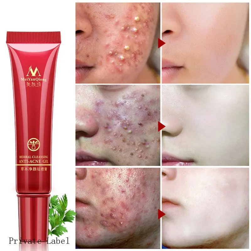 Chinese kruiden Selling acne care cream beste gezicht Verwijderen anti acne spot Litteken Behandeling whitening Cream