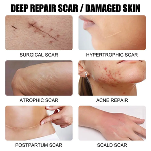 Kormesic 30ml Scar Gel <b>Cream</b> Private Label Custom OEM for Fast Acne Scar Bruises Tummy Tuck Repair Stretch Mark Removal - Product Image 3