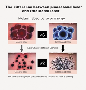 Tratamiento de la Piel - Láser de CO2 - Láser Nd-Yag - Eliminación de Tatuajes - Máquina de Rejuvenecimiento Facial y Vaginal - Product Image 2