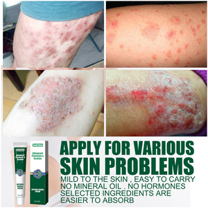 Crème hydratante et apaisante pour le <span class=keywords><strong>psoriasis</strong></span> et l'eczéma South Moon 20g, réduisant les démangeaisons - Product Image 4