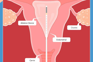 Appareil de raffermissement vaginal non invasif à usage gynécologique, hystéroscopie, colposcopie, utilisant des longueurs d'onde de 980 nm et 1470 nm - Product Image 4