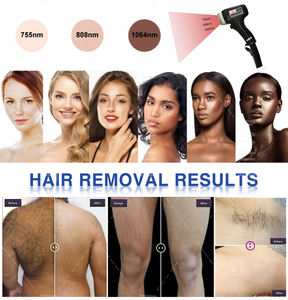 MNLT 2024 Équipement d'épilation laser professionnel 2 pièces avec effet de refroidissement par la glace Origine de la Turquie - Product Image 2