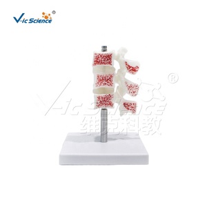 <span class=keywords><strong>Modello</strong></span> Anatomico Deluxe dell'Osteoporosi Umana PreNext con Icone Simili e Sezioni Trasversali - Product Image 3