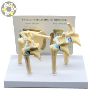 Médico enfermo 4 etapa osteoartritis <span class=keywords><strong>hombro</strong></span> modelo de enseñanza - Product Image 2