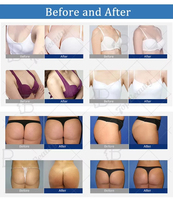 Appareil de thérapie par le vide Starvac SP2 pour le remodelage corporel, le lifting des fesses, l'amélioration mammaire, le massage par rouleaux sous vide et la réduction de la cellulite