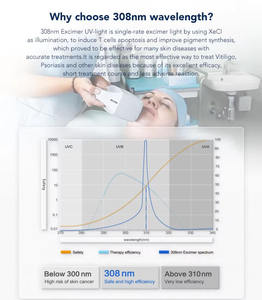 커널 CN 308E 긴 수명 LED 308nm 엑시메 기계 308nm 백반증 헤르페스 치료를위한 대상 광선 요법 램프 - Product Image 3