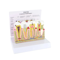 Modèle de pathologie dentaire Modèles de dents dentaires Modèle d'anatomie de la carie en plastique Équipement éducatif détachable médical Formation des dents