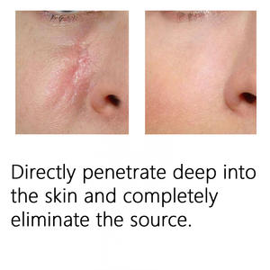 Crème avancée pour cicatrices, crème idéale pour les cicatrices anciennes, crème pour les cicatrices chéloïdes, TKA pour la vente au détail - Product Image 2