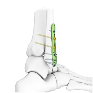 Sistem Implan Fiksasi Fraktur Tulang Pelat Pengunci Trauma Bedah Ortopedi Titanium untuk Tulang Humerus, Femur, Tibia, dan <span class=keywords><strong>Radius</strong></span> - Product Image 1