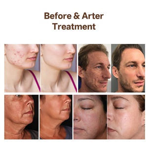 Appareil de beauté laser Thulium 1927 nm non-ablatif pour le rajeunissement fractionnel de la peau, le traitement du mélasma et des cicatrices d'acné - Product Image 5