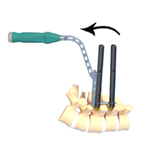 Vite pedicolare universale in titanio di alta qualità a passo variabile, a coda corta, per impianto ortopedico Miko II, per operazioni manuali sulla colonna vertebrale - Product Image 2