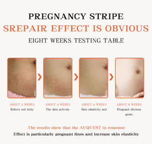 Crème anti-vergetures pour le corps, lotion naturelle contre les vergetures, les cicatrices, soin de la peau, efficace - Product Image 5