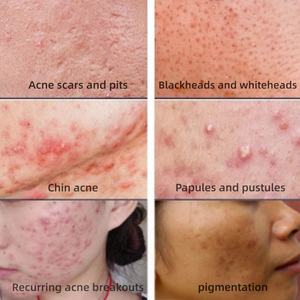 Soluzione per <span class=keywords><strong>Peeling</strong></span> Chimico BHA per Acne e Depigmentazione, Siero all'Acido Salicilico, <span class=keywords><strong>Peeling</strong></span> Chimico BHA per Esfoliazione Professionale del <span class=keywords><strong>Viso</strong></span> - Product Image 3