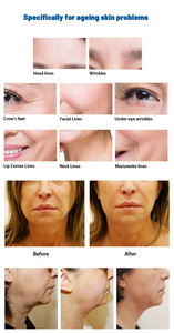 Máquina de Reducción de Papada y Grasa Abdominal con Succión al Vacío, Reafirmante Facial Antienvejecimiento, Reduce Arrugas, Novedad 2025 - Product Image 5