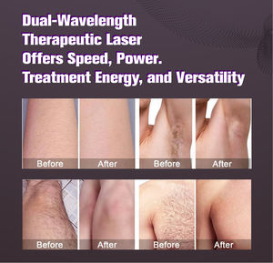 Nd Yag 755nm 1064nm Tattoo Removal Long Pulse Android System Alexandrite <span class=keywords><strong>Laser</strong></span> Hair Removal Machine Price With Cooling - Product Image 5