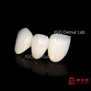 Laboratoire dentaire professionnel fabrication Pfz zircone couronnes dents molaires esthétique <span class=keywords><strong>prix</strong></span> abordable - Product Image 6