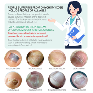 Extracto de jengibre Paroniquia Esencia de uñas Tratamiento <span class=keywords><strong>Hongo</strong></span> Dañado Reparación de uñas Suero antibacteriano para uñas - Product Image 4