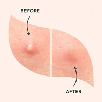 Patchs Hydrocolloïdes Anti-Acné Effet Immédiat pour Boutons et Points Noirs – Personnalisation Possible – Offre Spéciale Usine
