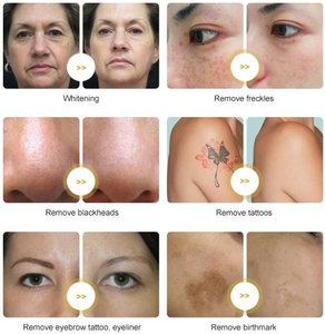 Fabriek Prijs Pico Tweede Carbon Peeling Q-Switched Laser 1064 1320 532 + 755nn + Zicht Machine Voor Nd Yag Tattoo Verwijdering - Product Image 4