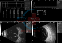 Scanner à ultrasons ophtalmique numérique complet HC-Q034A A/B, ultrasons oculaires