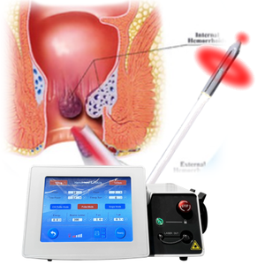 <span class=keywords><strong>Hemorroides</strong></span> Cirugía de fibra cónica 1470nm 980nm Proctología médica Fístula anal Pilas Recto Sinus Diodo <span class=keywords><strong>Tratamiento</strong></span> de corte - Product Image 1