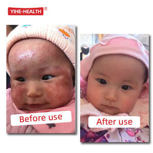 YIHE-HEALTH 피부 수리 크림 기저귀 발진 크림 어린이의 습진 - Product Image 3