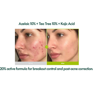 [Purito] Sérum para el Acné con Ácido Azelaico 10, Ácido Kójico y Árbol de Té 30ml, con Control de Sebo de Árbol de Té y Sérum Iluminador con Ácido Kójico - Product Image 6