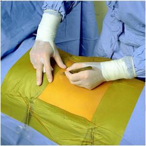 3 m 이오반 2 항균 절개 드레이프 10 팩 6650EZE 외과용 테이프 드레이프 - Product Image 5