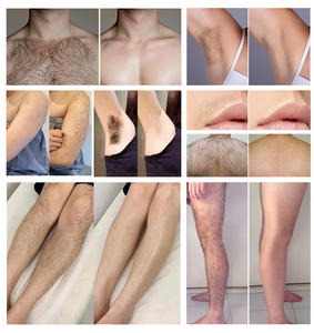 เครื่องเลเซอร์ IPL 3 in 1 กำลังไฟ 1000 วัตต์ ราคาสุดคุ้ม สำหรับกำจัดขนถาวร ยกกระชับใบหน้า และตัดกระจก-ใช้ได้ทั้งในเชิงพาณิชย์และที่บ้าน - Product Image 6