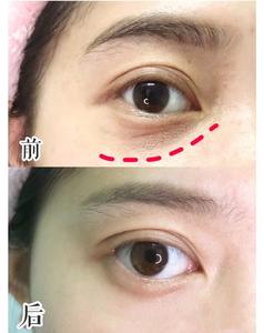 Chất Lượng Cao Hàn Quốc Mắt Làm Săn Chắc Nâng <span class=keywords><strong>Massage</strong></span> Ngay Lập Tức Mặt Mắt Cổ Hàm Nâng Máy Trên Bán - Product Image 6