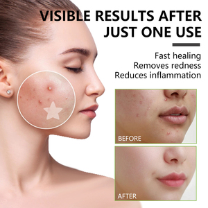 Tùy chỉnh hình dạng tại chỗ mụn mụn vá, có chứa axit salicylic và dầu cây trà, Hydrocolloid mặt chống mụn trứng cá vá - Product Image 4