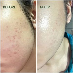 ETRUN ALISA <span class=keywords><strong>Effaclar</strong></span> Siero Trattamento Acne con Acido Salicilico 1,5% SA e Niacinamide per Pelle Soggetta a Imperfezioni, Essenza Anti-Acne - Product Image 6