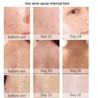 Portable Visage Brume Organique Acide Glycollique Huile D'arbre À Thé Anti Acné Dos Corps Visage Toner Brume Visage Spray