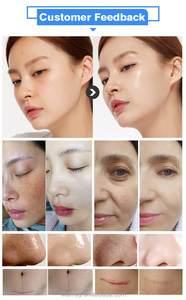 Stylo de peeling à jet d'oxygène de dernière technologie, machine de soin du visage et des cheveux par thérapie O2, peeling sans injection WM-A27B - Product Image 6
