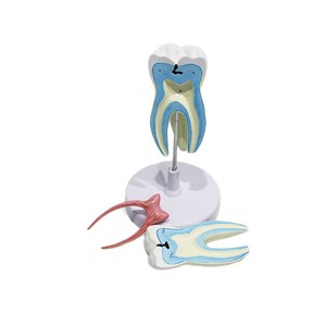 Modèle de molaires modulaire en trois parties, représentant la structure d'un dentier cariote, utilisé comme outil pédagogique et de formation en milieu scolaire - Product Image 5