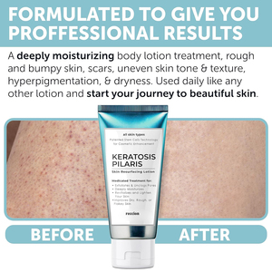 Người lớn keratosis pilaris Lotion bó Bộ hữu cơ làm trắng sáng chân dâu tây Vitamin C vết sưng tẩy phụ nữ - Product Image 4