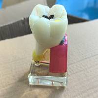 Modelo Anatómico de Molar Patológico Dental de 4 Veces el Tamaño Real, Simulación de Perfil de Caries, Modelo de Enseñanza para Entrenamiento Dental