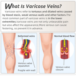 Chaussettes <span class=keywords><strong>de</strong></span> compression médicales pour femmes, <span class=keywords><strong>classe</strong></span> <span class=keywords><strong>2</strong></span>, hauteur cuisse, 20-30 mmHg, bout ouvert, antidérapantes, pour varices et gonflements - Product Image 4