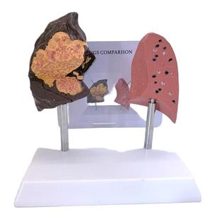 Modelo comparativo para pulmón <span class=keywords><strong>de</strong></span> <span class=keywords><strong>fumador</strong></span> vs equipo educativo <span class=keywords><strong>de</strong></span> pulmón normal - Product Image 2