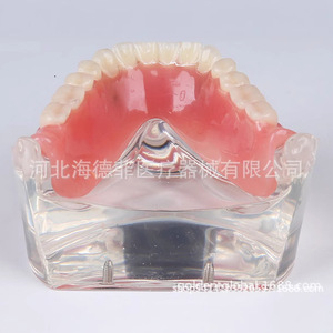 Modèle d'implant dentaire maxillaire et mandibulaire à 2 ou 4 vis en silicone médical pour la formation dentaire - Product Image 1