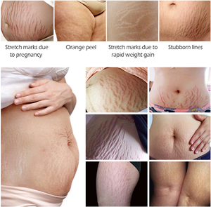 Coccodrillo Smagliature Crema di Rimozione Ance Di Maternità Riparazione Anti Invecchiamento Chiocciole Rassodante Cura Del Corpo Gravidanza Cicatrici - Product Image 4