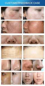 Professional Multi-functional Skin Rejuvenation <b>Machine</b> for Repairing Damage and Improving Skin - Product Image 6