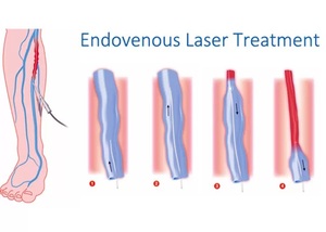 इलेक्ट्रिक 980nm 1470nnm 1940nm डायोड लेजर मशीन के साथ एंडोवेनस एब्लेशन के लिए एयर कूल्ड सिस्टम के साथ - Product Image 2