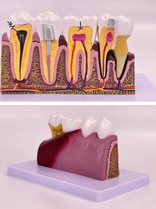 Modèle de caries dentaires pathologiques, modèle pédagogique complet de pathologie dentaire, modèle anatomique du dôme dentaire - Product Image 4