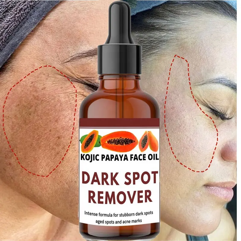 Kojic Papaya Gesichts öl Dunkle Flecken Entferner Gesichts serum für dunkle Flecken Alter Flecken Akne Markierungen Hautun reinheiten Verfärbungen Sonnenbrand